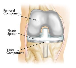 Ouro Knee Implant